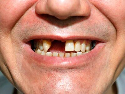Men smile with two front teeth missing
