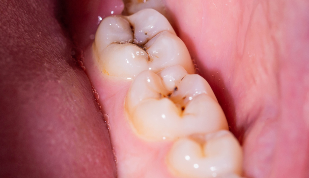 dental cavities - D4