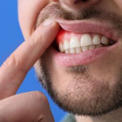 gingivitis-gum disease