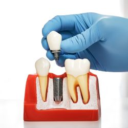 dental implant - descriptive image