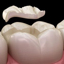 dental inlay on lower first molar