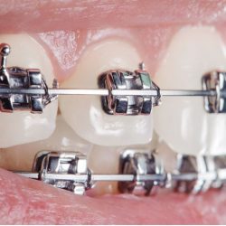 orthodontics (3)