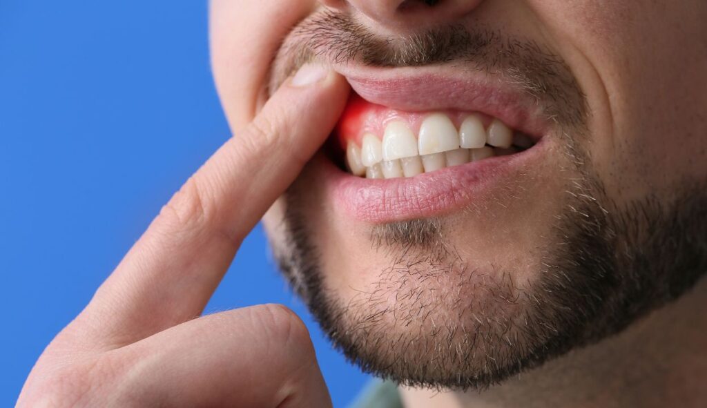 gingivitis-gum disease