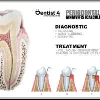 stage 1 of gum disease - gingivitis