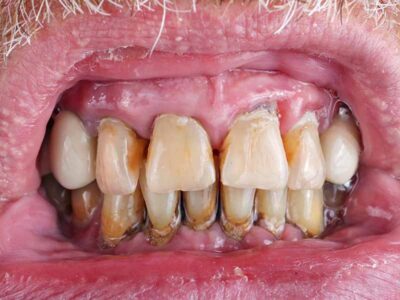 The teeth of a man are spoiled by caries, needing a periodontics procedure