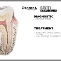Incipient caries - stage 1 of dental caries