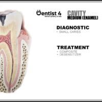 Dental caries limited to the enamel - stage 2 of dental caries