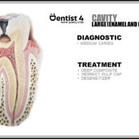 Dental caries extending into dentin - stage 3 of dental caries