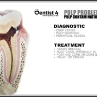 deep dental caries involving the pulp requiring root canal treatment due to pulp necrosis and periapical abcess